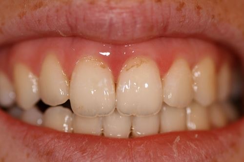 Особенности лечения эрозии твердых тканей зуба